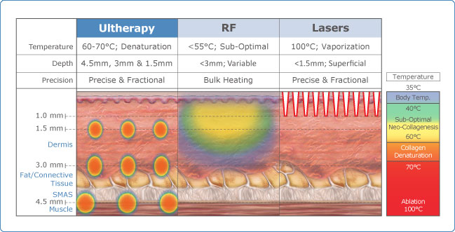 What Is HIFU / Ultherapy Treatment?
