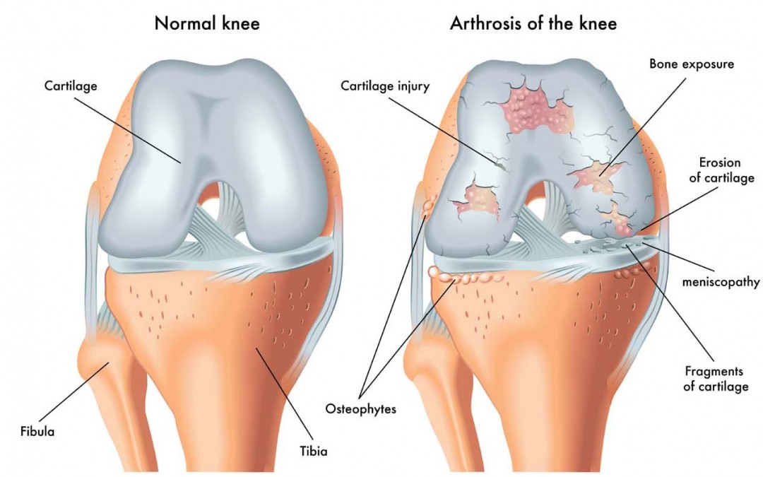 Platelet Rich Plasma (PRP) Treatment For Knees