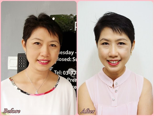 Aunty Lily’s Experience with Ultherapy Skin Lightening & Lifting