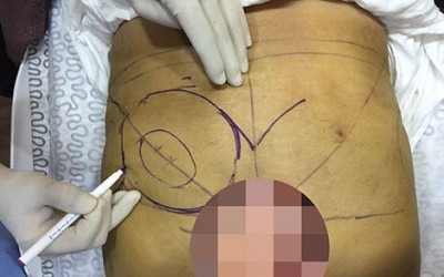 Buttocks Enhancement with Dermal Filler Injection in Kuala Lumpur