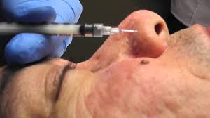 Steroid injection. Nodular and cystic lesions can be treated by injecting a steroid drug directly into them. This improves their appearance without the need for extraction. The side effects of this technique include thinning of the skin, lighter skin and the appearance of small blood vessels on the treated area.