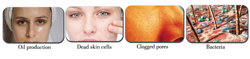 causes-of-acne