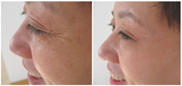 Tired of seeing wrinkles on your face as you age?