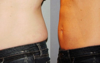 CoolSculpting – One of the best solutions to your weight problems