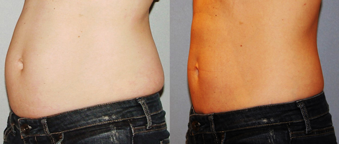 CoolSculpting – One of the best solutions to your weight problems