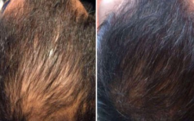 Premier Stem Cell Hair Loss Treatment explained by Dr Kee Yong Seng