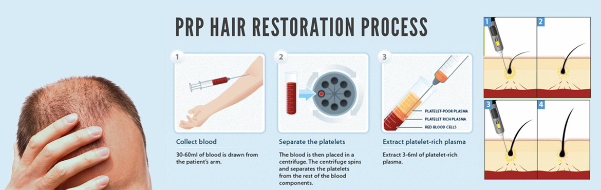 Platelet-Rich-Plasma-for-Hair-Growth
