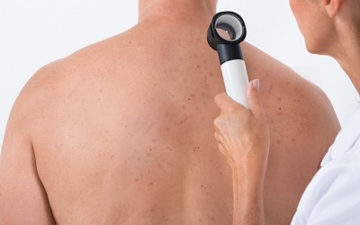 Back Acne: Causes, Self-Care and Treatment