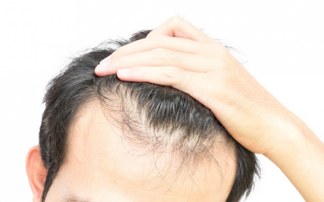 How to Cope with Hair Loss for Men?