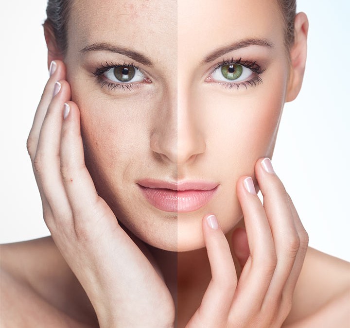 Enhance Your Appearance with Fractional CO2 Laser