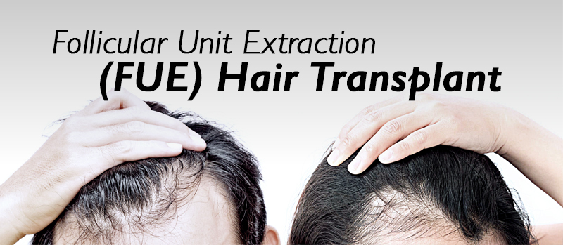 Follicular Unit Extraction (FUE) Hair Transplant | KL Aesthetic