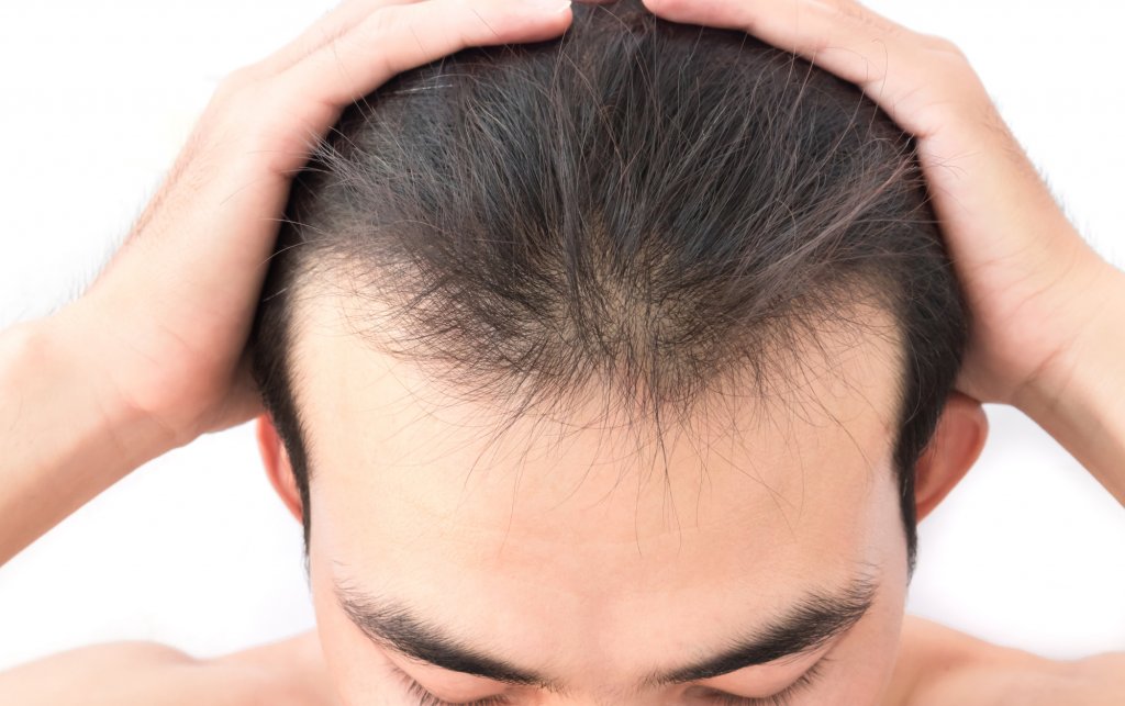 When Should You Start Worrying About Hair Loss?