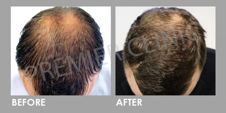 FUE Hair Transplant Before After 