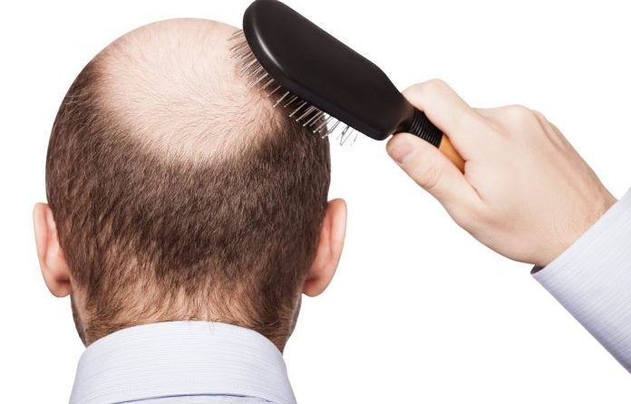 Hair Loss for Men