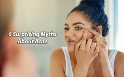 6 Surprising Myths About Acne