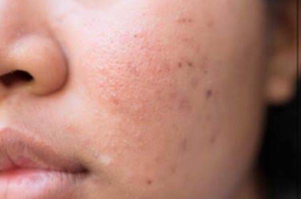 Acne Scars Are All Similar