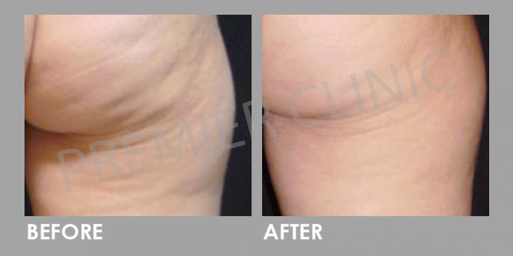 Cellulite Before After