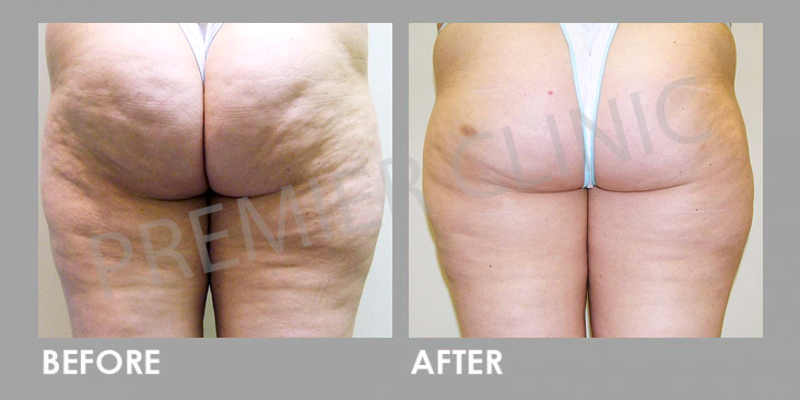 Cellulite Before After