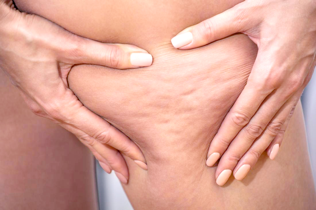 What is Cellulite?