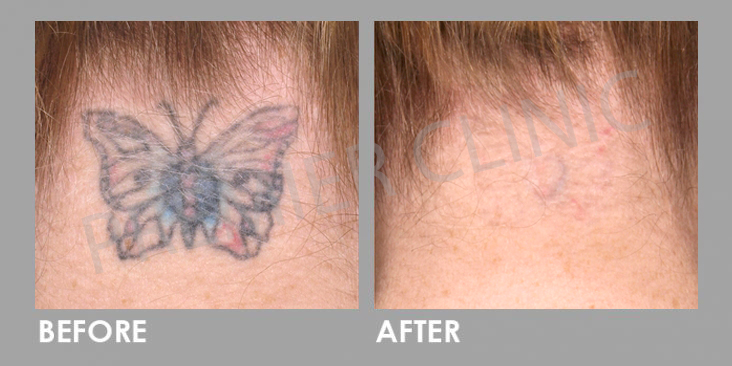 PICO Laser for tatto removal Before After 01 KL Aesthetic