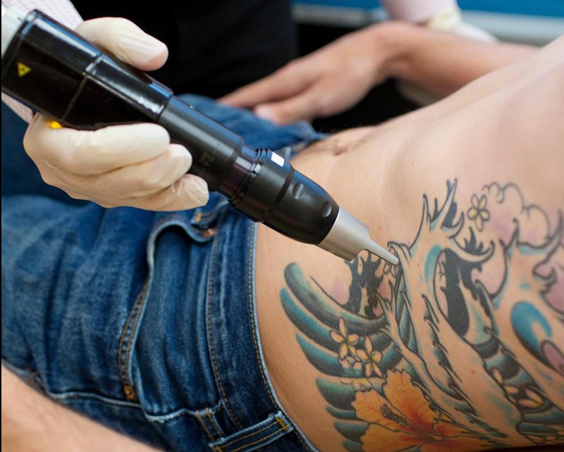REMOVING TATTOO IS EASIER NOW WITH PICO LASER | KL Aesthetic