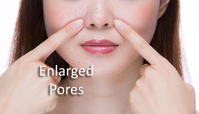 Common Causes of Enlarged Pores