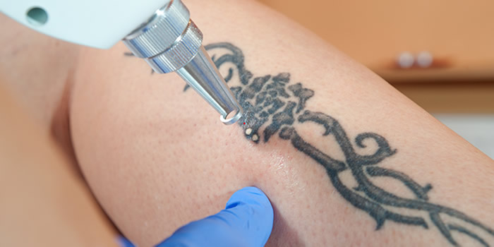 Picosure-laser-tattoo-removal-premier-clinic