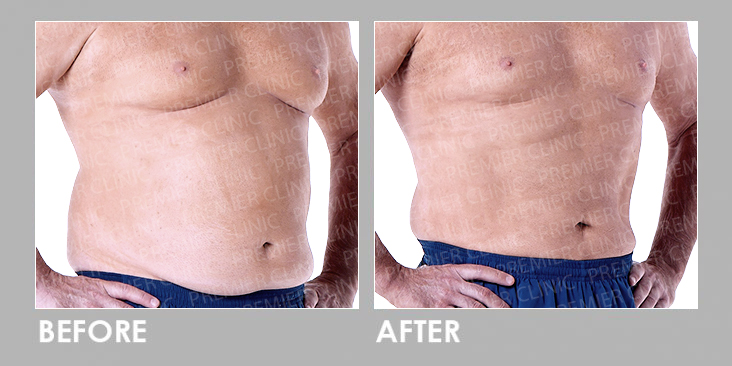 BEFORE & AFTER LIPOCELL BODY RESHAPING  